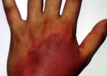 MANAGEMENT OF BURNS AND SCALDS